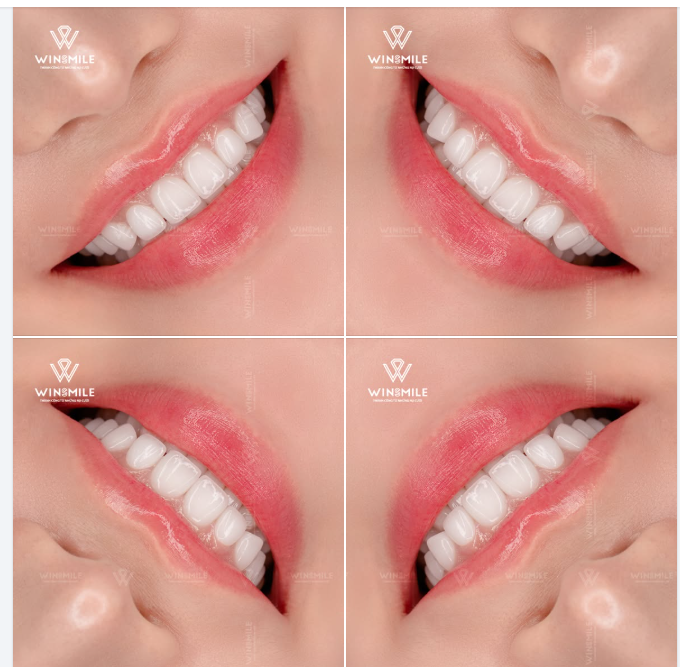 Giữa một thời đại mà người ta dễ dàng bị cuốn theo những khuôn mẫu hoàn hảo, Win Smile chọn một lối đi lặng lẽ nhưng bền bỉ hơn: Khơi dậy lại bản sắc cho từng nụ cười riêng biệt