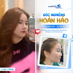 GÓC NGHIÊNG HOÀN HẢO SAU 1 THÁNG NÂNG MŨI