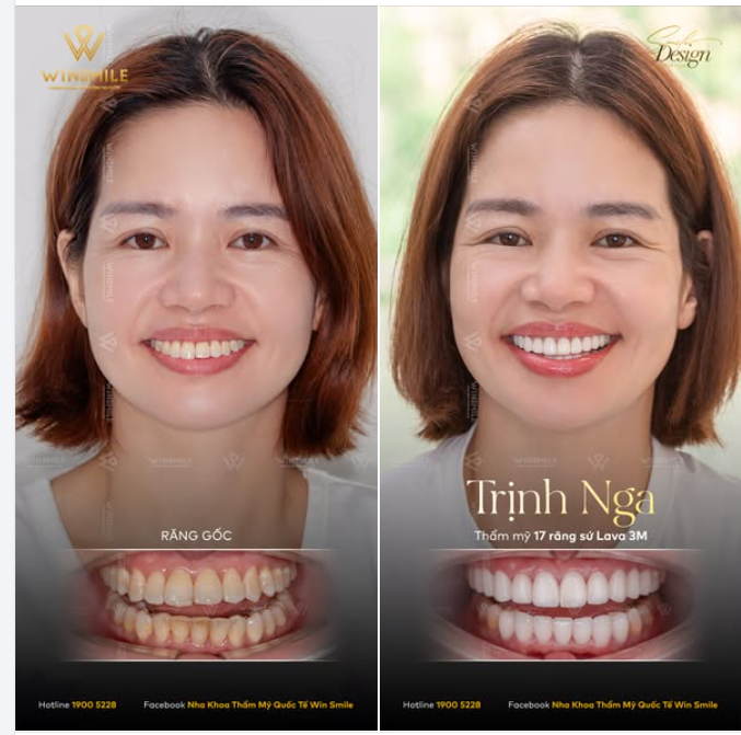Đã bao giờ bạn bắt gặp mình trong gương, nhìn ngắm một nụ cười mím chặt hoặc một cái lấy tay che miệng vội vã chưa?