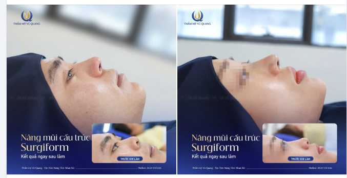 NÂNG MŨI CHÀO HÈ 2026: ĐỪNG CHỈ ĐI CHƠI, HÃY ĐI ĐỔI ĐỜI NHAN SẮC!