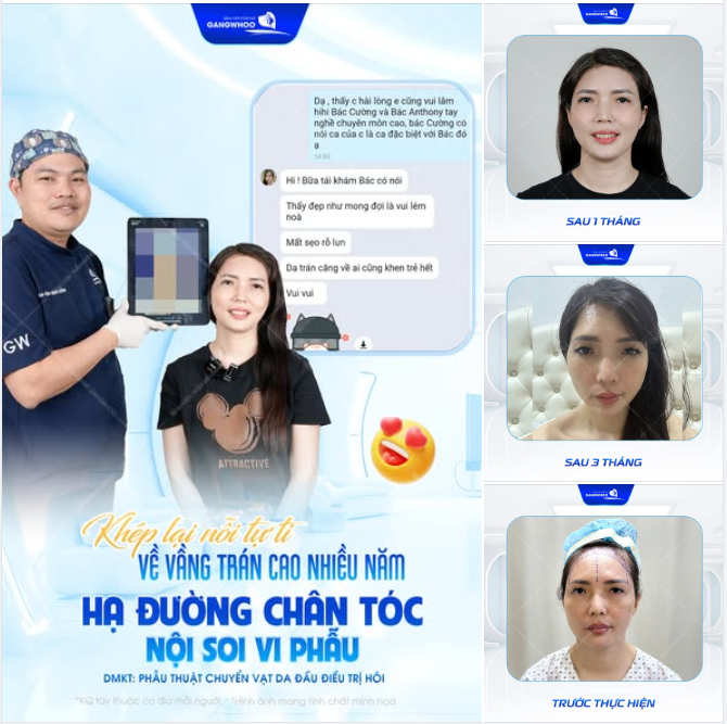 KHÉP LẠI NỔI TỰ TI VỀ VẦNG TRÁN CAO NHIỀU NĂM