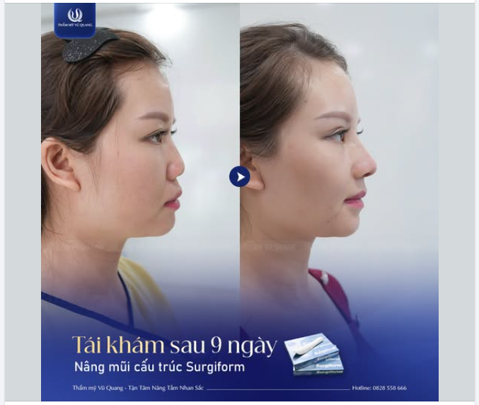 GÓC NGHIÊNG THẦN THÁNH CHỈ SAU 9 NGÀY NÂNG MŨI SURGIFORM