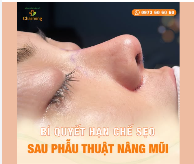 BÍ QUYẾT HẠN CHẾ SẸO SAU PHẪU THUẬT MŨI