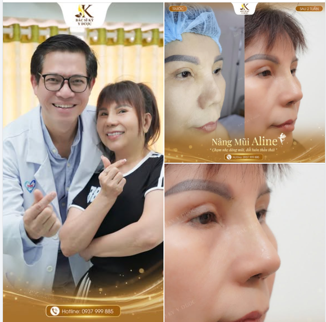 Nâng Mũi Aline  Từ hài hòa đến nổi bật