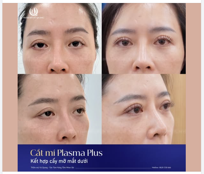 30 PHÚT CẮT MÍ – TRẺ RA 5 TUỔI CÙNG THẨM MỸ VŨ QUANG!