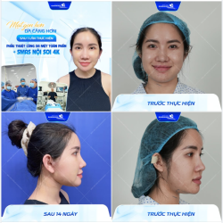 MẶT GỌN HƠN - DA CĂNG HƠN SAU 1 LẦN THỰC HIỆN