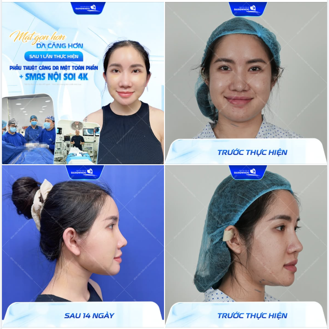 MẶT GỌN HƠN - DA CĂNG HƠN SAU 1 LẦN THỰC HIỆN