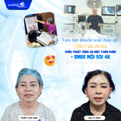 TẠM BIỆT KHUÔN MẶT CHẢY XỆ NHỜ 1 LẦN TRẺ HÓA