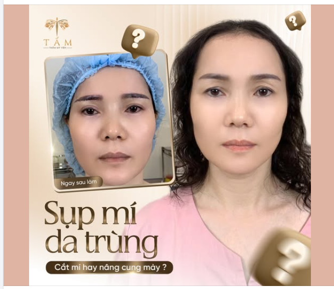 CẮT MÍ hay NÂNG CUNG MÀY?