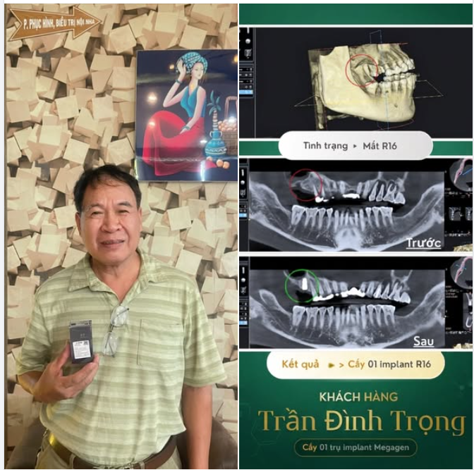 KHÔI PHỤC RĂNG HÀM MẤT LÂU NĂM BẰNG IMPLANT