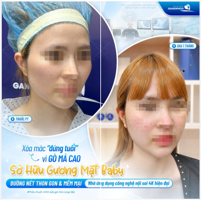 XÓA MÁC ĐỨNG TUỔI VÌ GÒ MÁ CAO