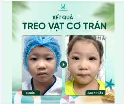 Sự thay đổi sau 7 ngày Treo VCT của bé Tú Quỳnh