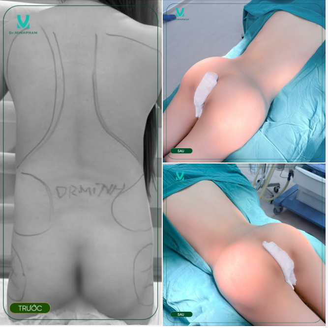 TÁI TẠO BODY QUYẾN RŨ