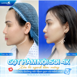 GỌT HÀM NỘI SOI 4K – XÓA BỎ GÓC HÀM VUÔNG