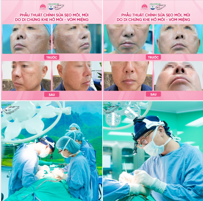 HÀNH TRÌNH CHỈNH SỬA DI CHỨNG KHE HỞ MÔI - VÒM CHO KHÁCH HÀNG NGƯỜI NHẬT BẢN
