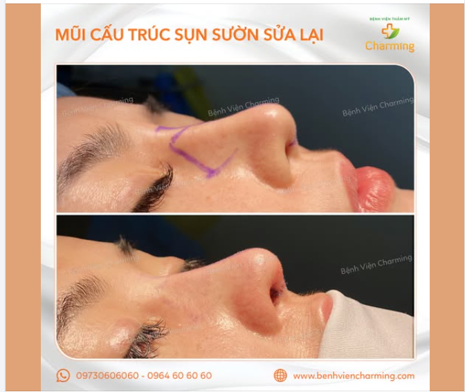 KHẮC PHỤC DÁNG MŨI BẰNG SỤN TỰ THÂN