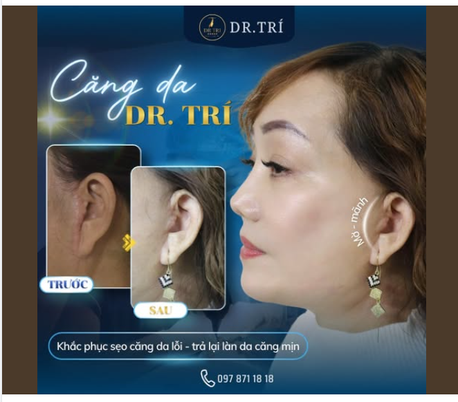 XÓA SẸO CĂNG DA LỖI – TRẢ LẠI LÀN DA KHÔNG TÌ VẾT