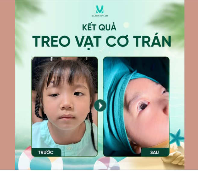 TREO VCT – ĐIỀU TRỊ MẮT SỤP MI