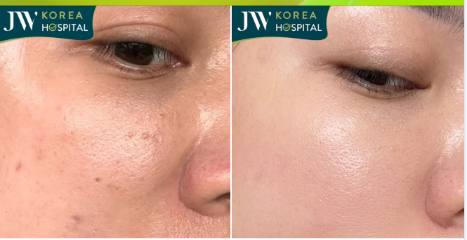 DA SẠM, THÂM MỤN TRANG ĐIỂM CỠ NÀO CŨNG KHÔNG ĐẸP?