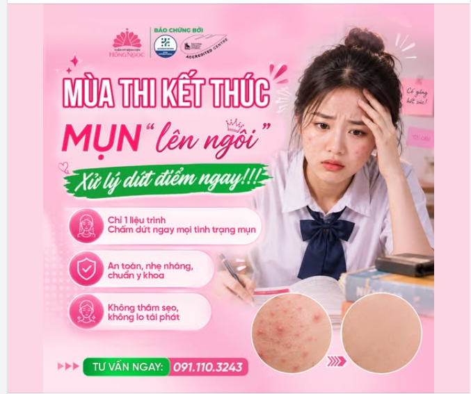 MÙA THI KẾT THÚC - MỤN "LÊN NGÔI"?  ĐỪNG ĐỂ MỤN "CHIẾM SPOTLIGHT" MÙA HÈ NÀY!