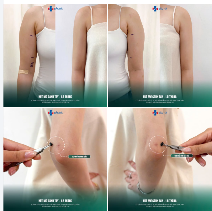 SOI CẬN VẾT SẸO SAU HÚT MỠ CÁNH TAY