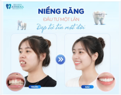 NIỀNG RĂNG - ĐẦU TƯ MỘT LẦN, ĐẸP TỰ TIN MỘT ĐỜI
