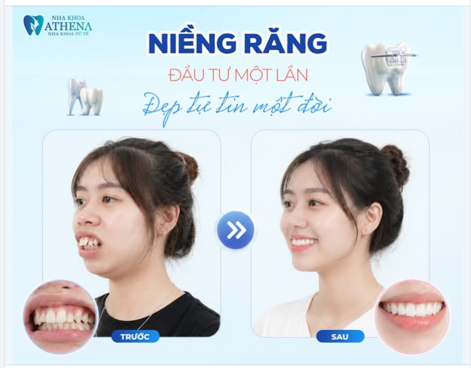 NIỀNG RĂNG - ĐẦU TƯ MỘT LẦN, ĐẸP TỰ TIN MỘT ĐỜI