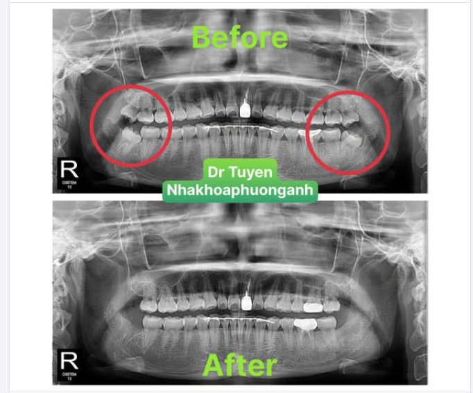 Tìm hiểu về răng khôn – Những điều cần biết