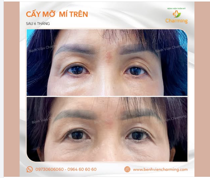 CẤY MỠ MÍ TRÊN - GIÚP ÁNH NHÌN THÊM HÀI HÒA