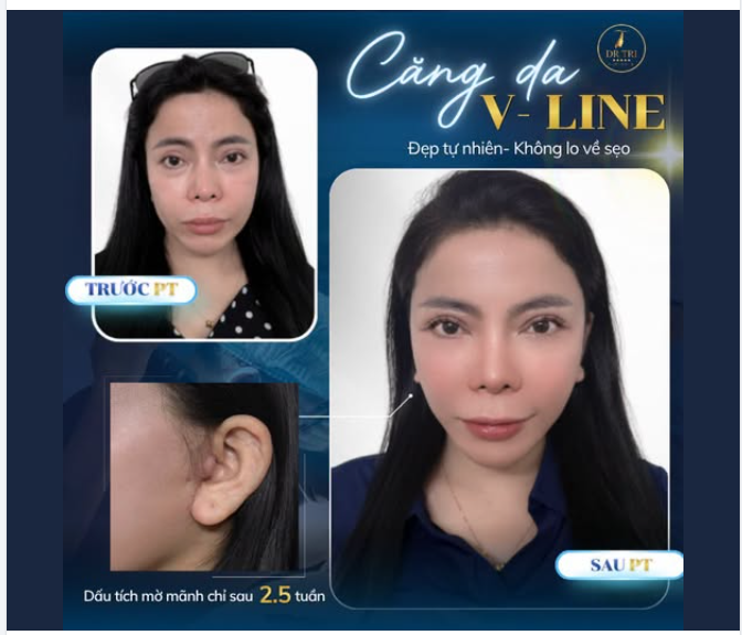 ĐÁNH BAY LÃO HÓA -KHÔNG LO SẸO XẤU TẠI DR. TRÍ