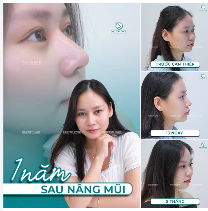 1 năm sau nâng mũi tại Dr Face