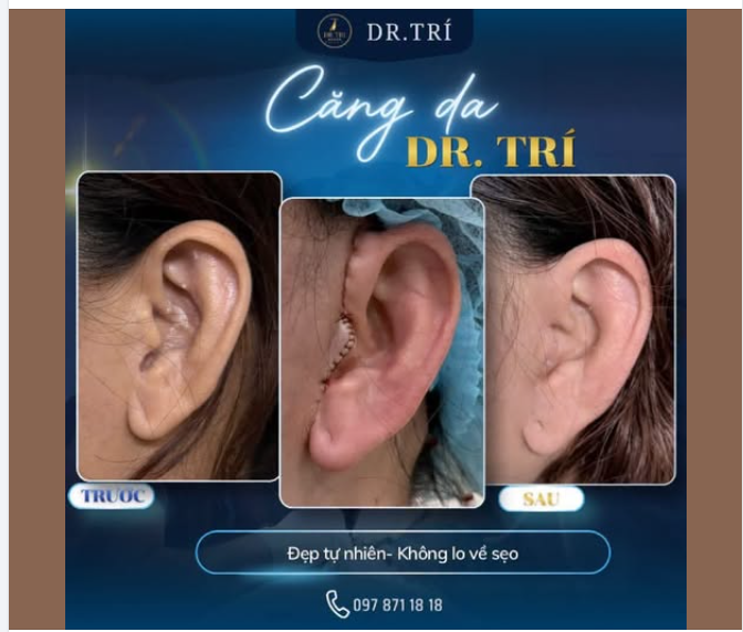 TRẺ RA 10 TUỔI – KHÔNG LO VỀ SẸO!