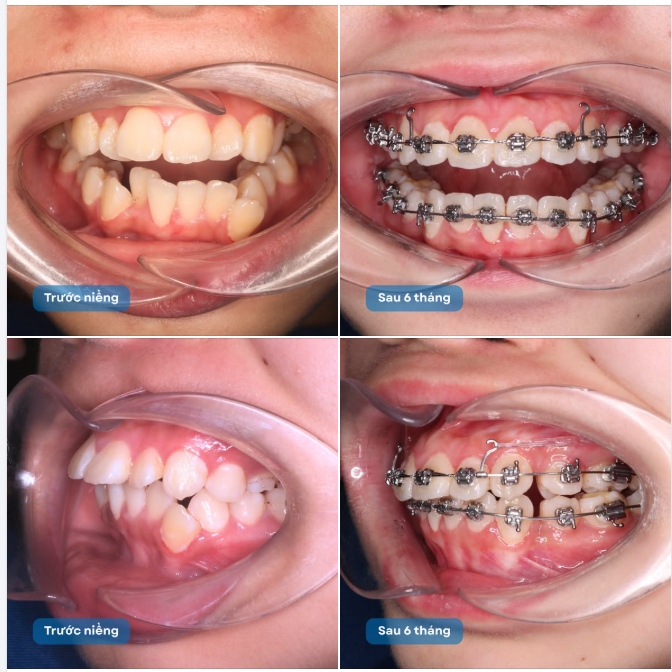 ĐIỀU GÌ ĐÃ THAY ĐỔI CHỈ SAU 6 THÁNG NIỀNG RĂNG?