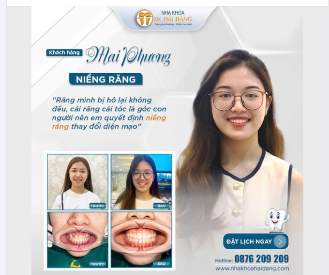 TỪ NỤ CƯỜI THIẾU TỰ TIN ĐẾN NỤ CƯỜI RẠNG RỠ – CA NIỀNG RĂNG THÀNH CÔNG