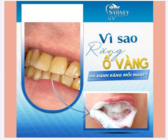 VÌ SAO RĂNG VẪN Ố VÀNG DÙ ĐÁNH RĂNG MỖI NGÀY?