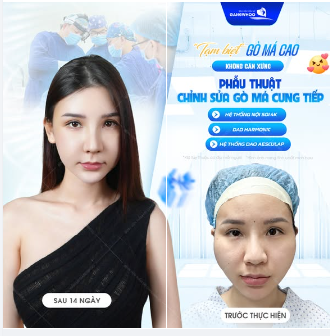 GƯƠNG MẶT HÀI HÒA MỀM MẠI HƠN CHỈ SAU 1 LẦN HẠ GÒ MÁ NỘI SOI VI PHẪU