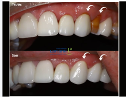Nhìn thì tưởng veneer bị hỏng... nhưng "thủ phạm" lại là chỗ khác.