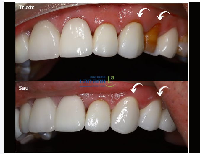 Nhìn thì tưởng veneer bị hỏng... nhưng "thủ phạm" lại là chỗ khác.