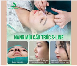 Nâng mũi cấu trúc S-line Dáng mũi mềm mại, chuẩn Á Đông