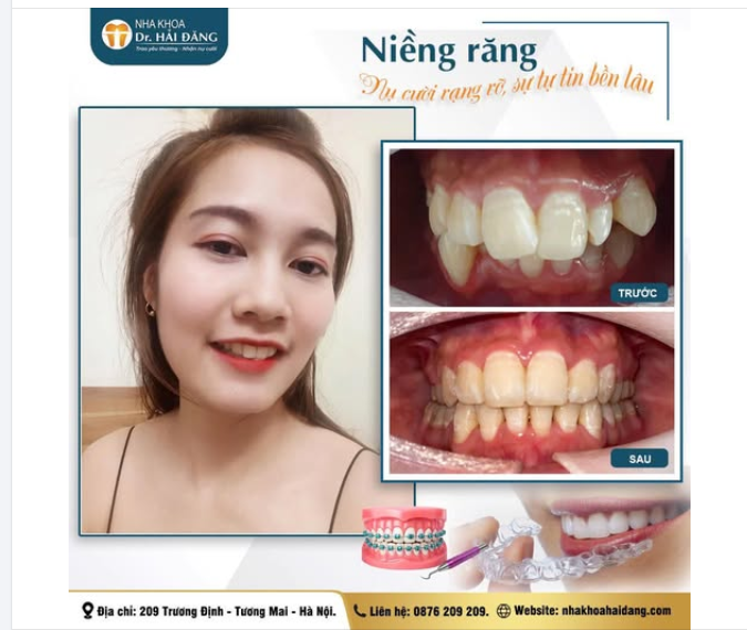 KẾT QUẢ XỨNG ĐÁNG SAU HÀNH TRÌNH NIỀNG RĂNG