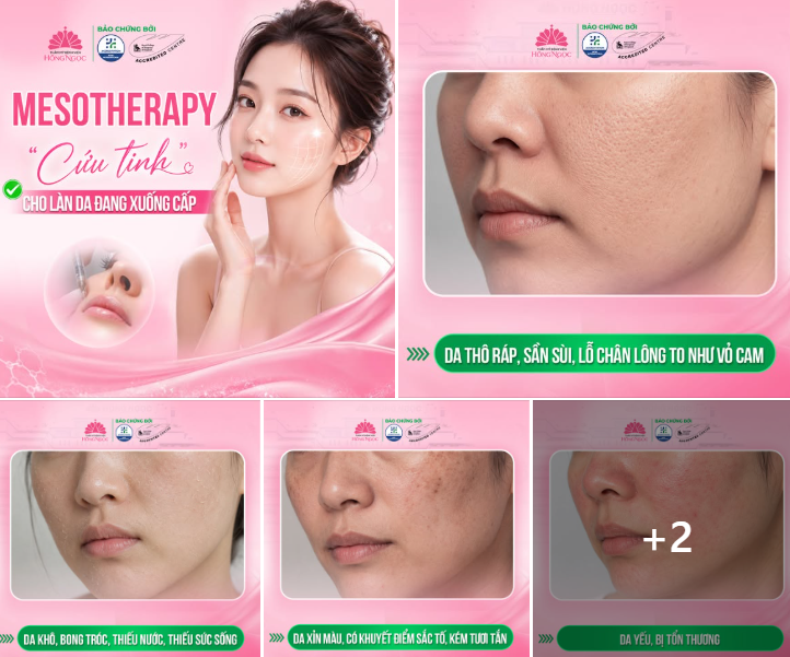 MESOTHERAPY - "CỨU TINH" CHO LÀN DA ĐANG XUỐNG CẤP