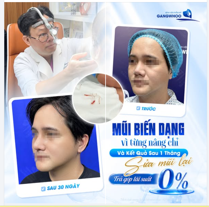MŨI BIẾN DẠNG VÌ TỪNG NÂNG CHỈ