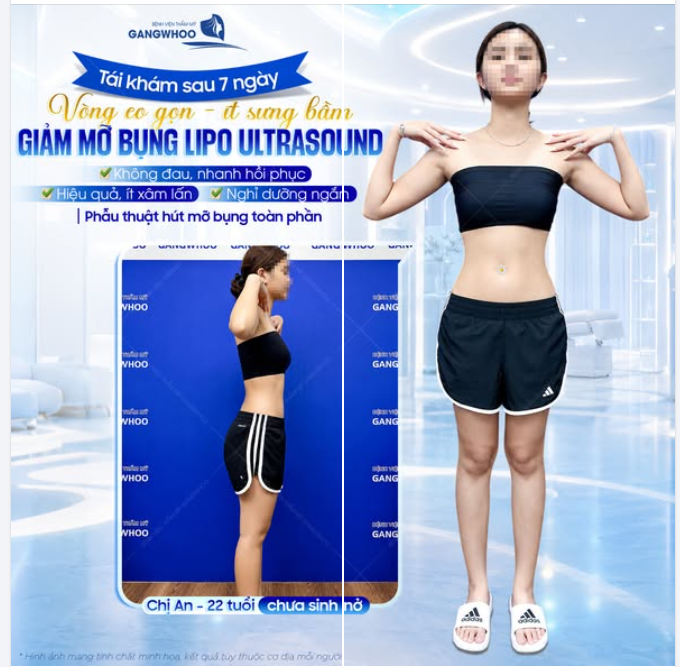 VÒNG EO GỌN - ÍT SƯNG BẦM