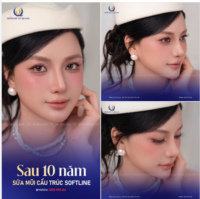 KẾT QUẢ SỬA MŨI CẤU TRÚC SAU 10 NĂM