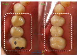 Có những mối quan hệ... đến lúc phải buông.  Giống như chiếc cầu răng sứ kim loại đã hoàn thành sứ mệnh của mình.