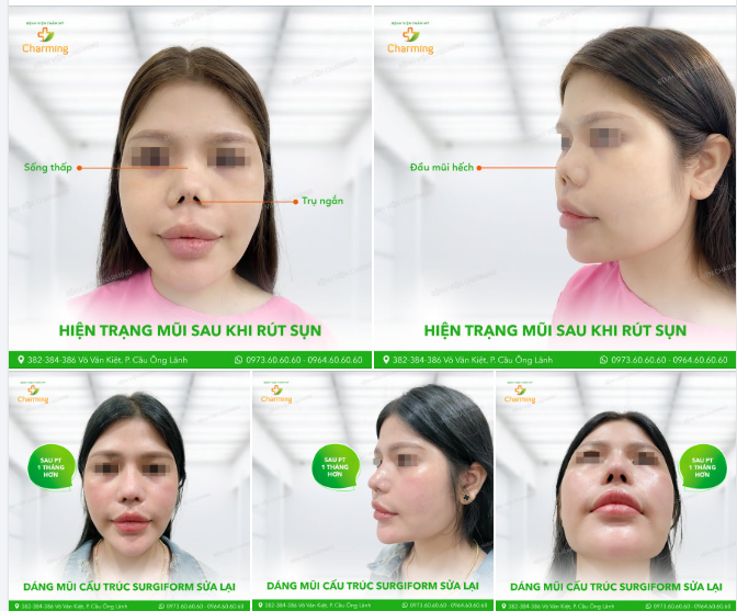 MŨI CẤU TRÚC - GIẢI PHÁP CHO NHỮNG TRƯỜNG HỢP MŨI KHÓ