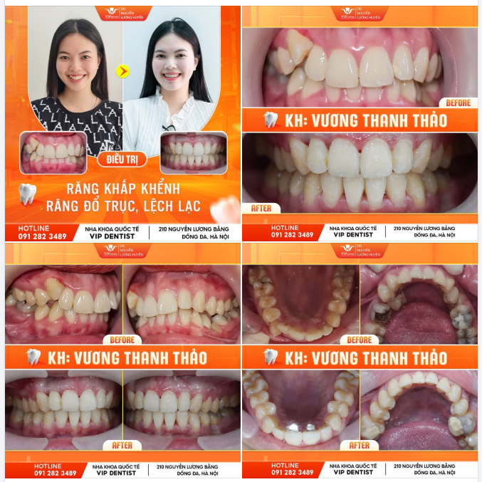 CƯỜI XINH - TỎA SÁNG NGÀY THÁO NIỀNG!
