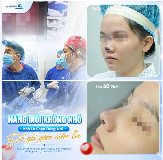 TẬU MỘT DÁNG MŨI ĐẸP KHÔNG KHÓ