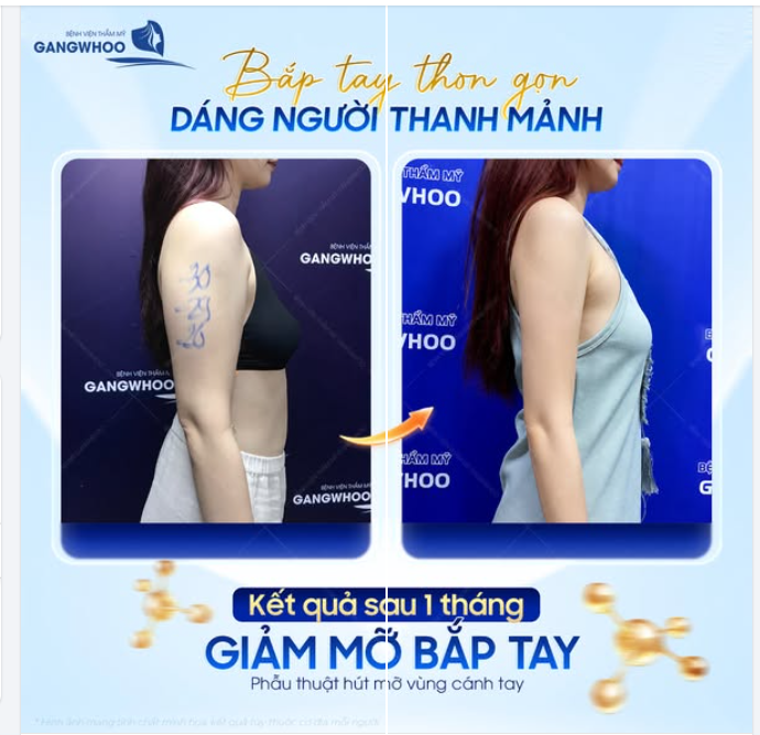 BẮP TAY THON GỌN - DÁNG NGƯỜI THANH MẢNH