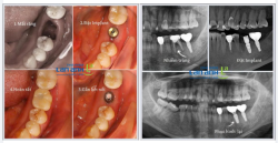 Khách bảo: “Cái Implant kế bên anh dùng như răng thật. Nếu răng này không giữ được thì cứ xử lý dứt khoát, nhổ rồi làm Implant giống bên kia là được.”